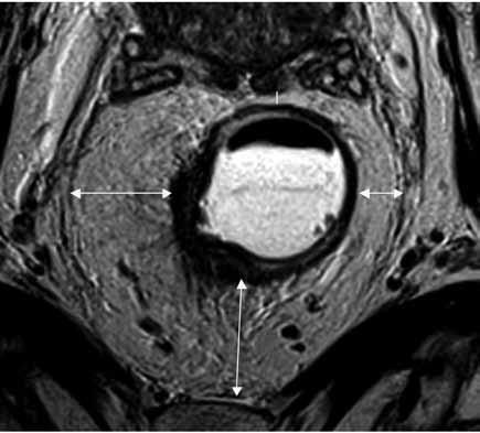 # Limitation of radiological T subclassification # treatment with curative intent (local failure).