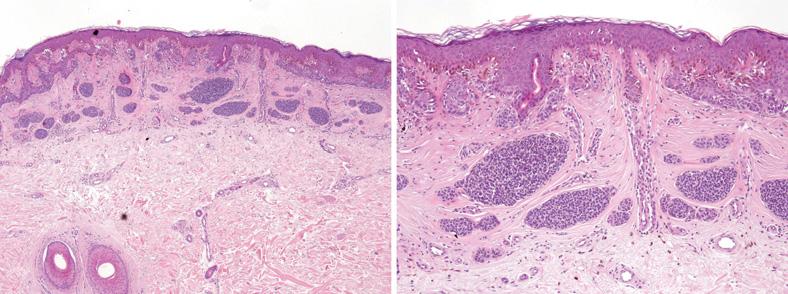 Grcar-Kuzmanov B et al. / Sclerosing melanocytic lesions 223 mas ranged from 0.4 to 1.8 mm (median, 0.75 mm).