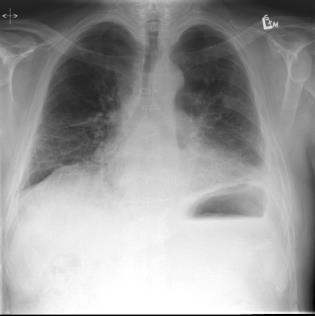 QUESTIONS CASE 1 76 year old smoker for assessment of RLL mass,on chest x-ray.