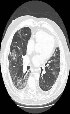 CASE 2 65 year old man with progressive shortness of breath, with SpO2 = 81% on room air.