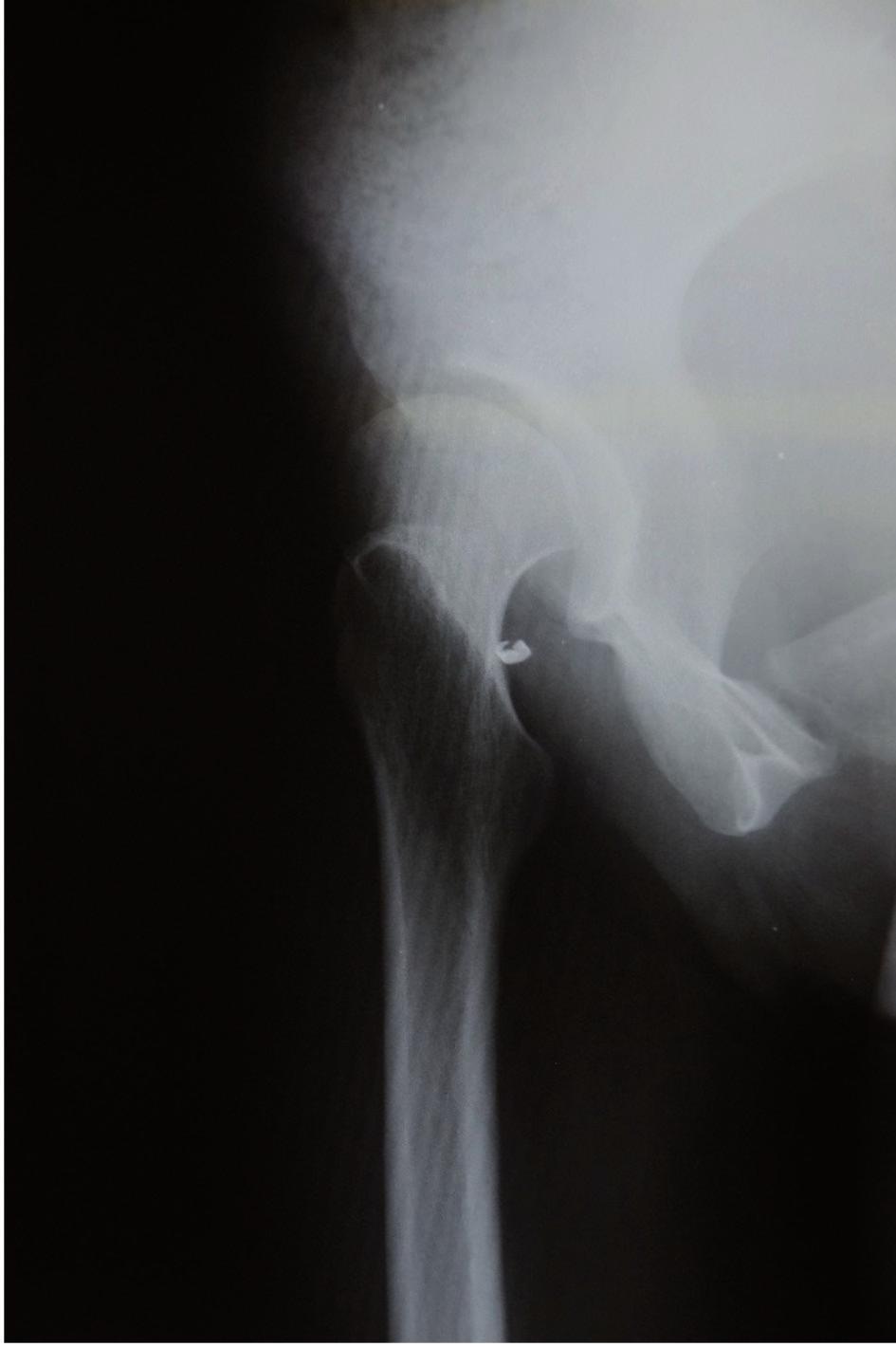 Patients and Methods We retrospectively reviewed 37 patients (42 hips) with symptomatic acetabular dysplasia who were treated with triple pelvic osteotomy between April 2007 and May 2012 (Figure 1,2).