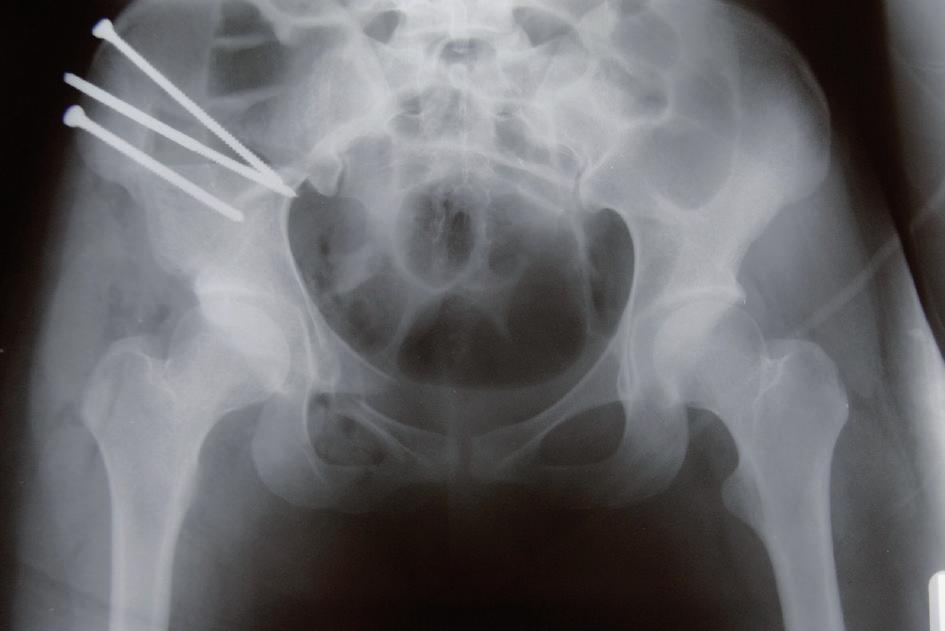 triple pelvic osteotomy for the treatment of symptomatic acetabular dysplasia 701 joint space narrowing) and 4 (9.