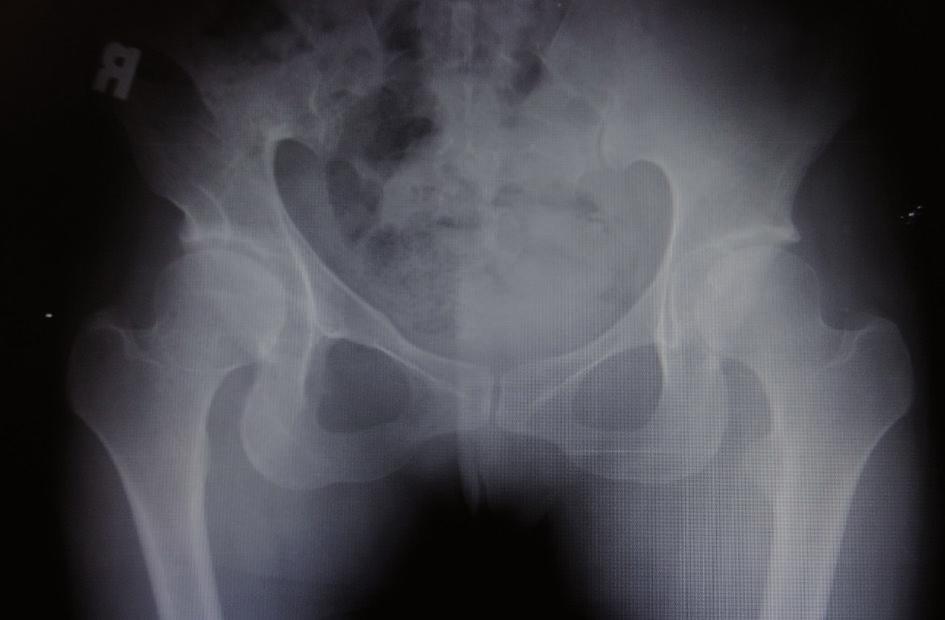 triple pelvic osteotomy for the treatment of symptomatic acetabular dysplasia 703 Fig. 4. AP pelvis radiography 7 years after the operation.