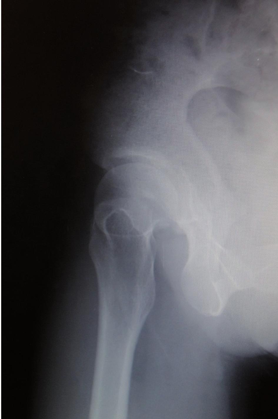 curve, which makes it a suitable treatment option for symptomatic acetabular dysplasia in adolescents and adults. References 1. Aminian A, Mahar A, Yassir W, Newton P, Wenger D.