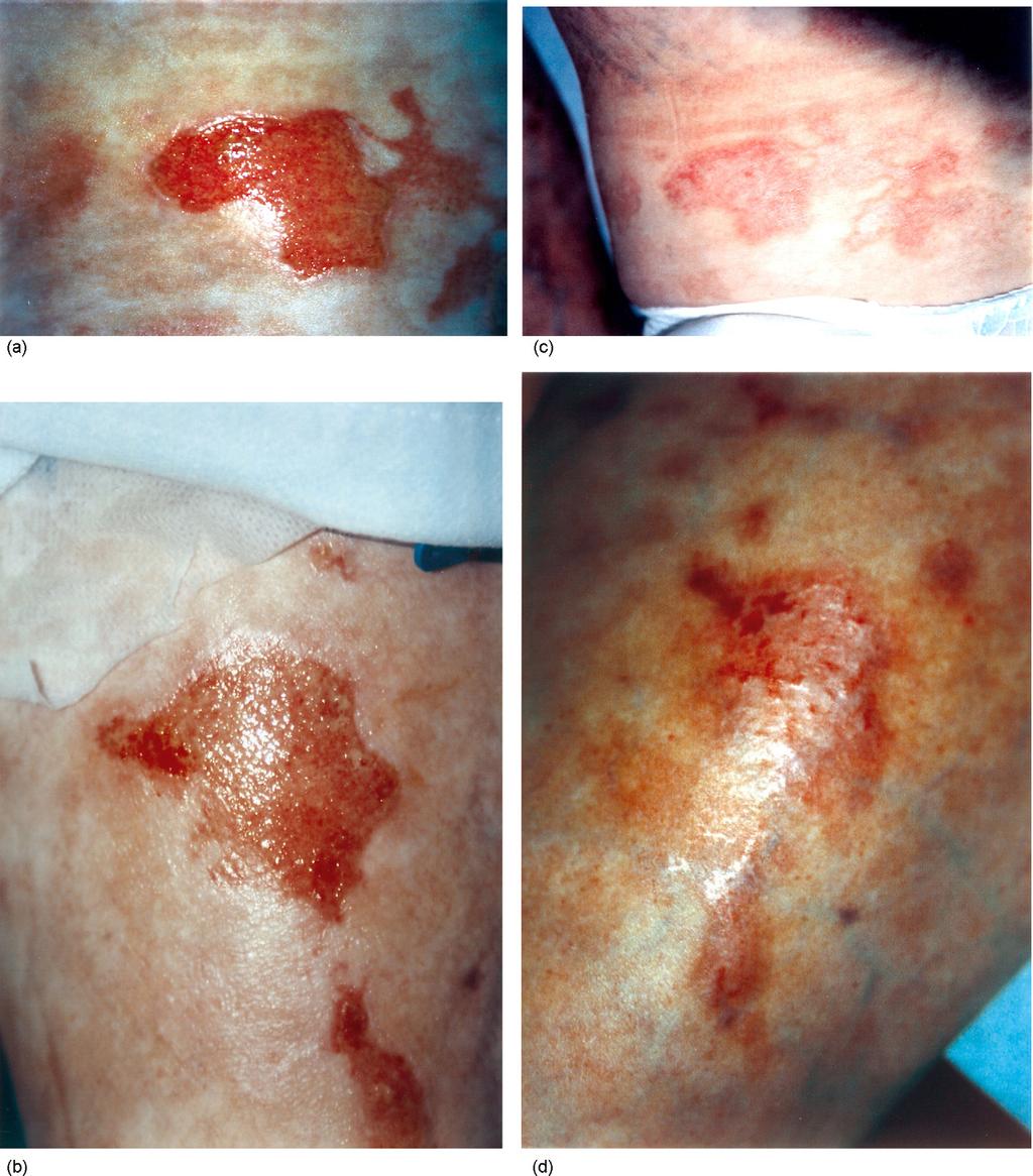 burns 33 (2007) 100 104 101 of keratinocyte allografts in TEN treatment is also questioned. 2.