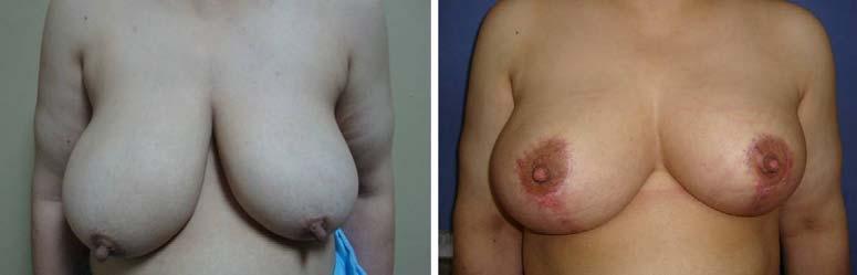(12) A gauze dressing is applied over the incisions. All excised breast tissues were sent for histopathological study.