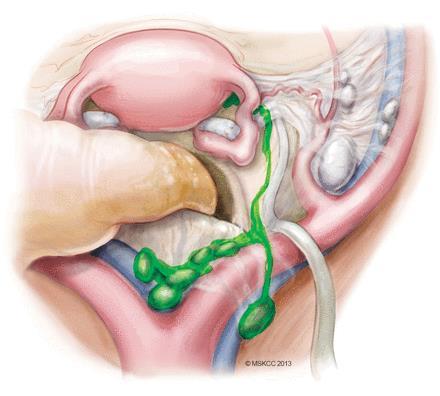 Drainage Routes After Cervical Injection