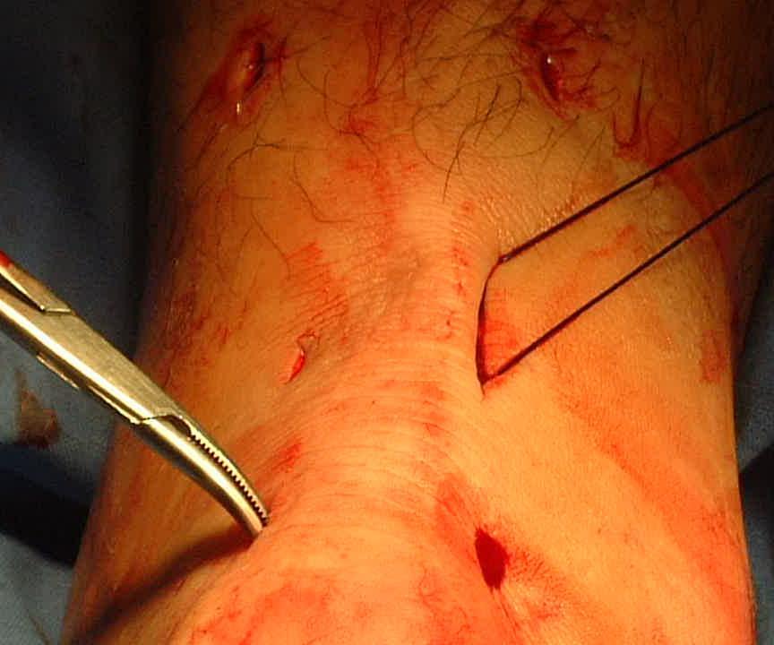 FREE THE TENDON SHEATH FROM OVERLYING