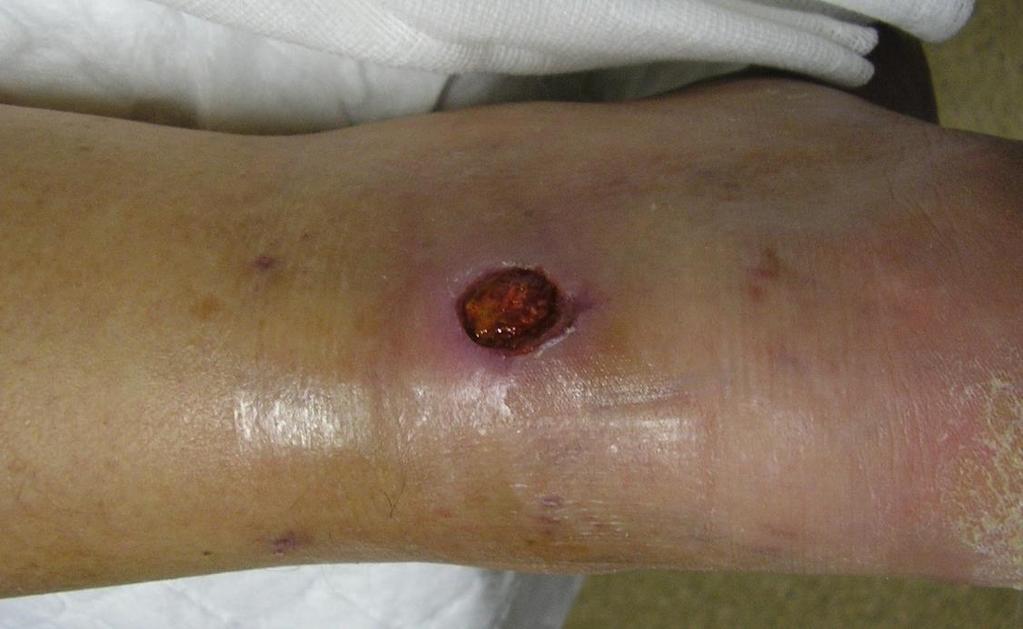 SERIES with 3 year follow-up: Case 50 1 wound