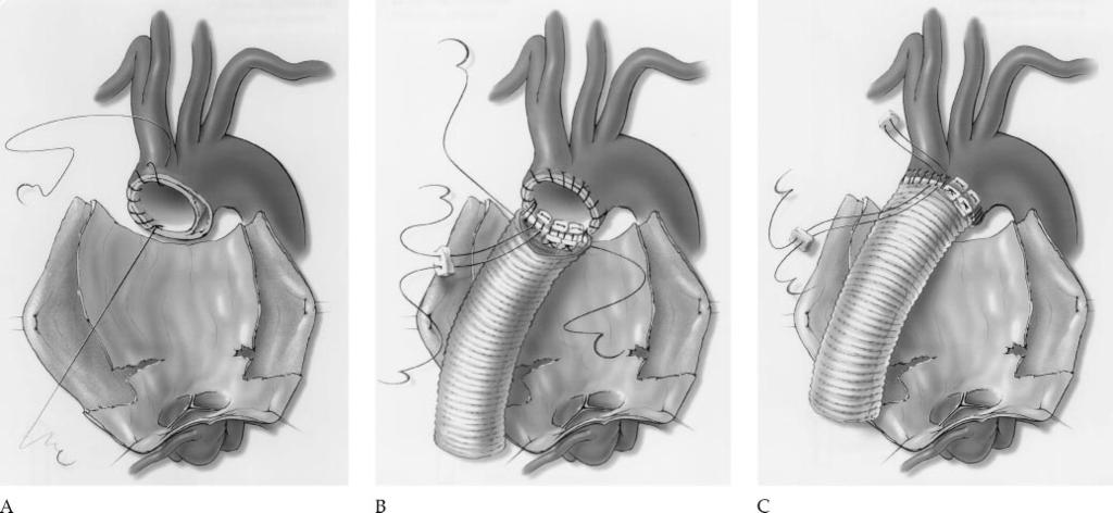 406 SAFI ET AL Ann Thorac Surg OPERATION FOR AORTIC DISSECTION: EARLY COMPLICATIONS 1998;66:402 11 Fig 1. (A) The intima and adventitia are sutured together.