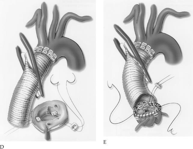 elephant trunk technique [5] was used in 1 of 44 (2%) acute dissection patients in which the dissection extended into the descending thoracic aorta. CHRONIC TYPE A DISSECTION.