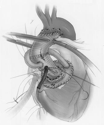 Ann Thorac Surg SAFI ET AL 1998;66:402 11 OPERATION FOR AORTIC DISSECTION: EARLY COMPLICATIONS 407 Fig 2. Composite valve graft with modified Cabrol reattachment of left coronary artery. apy.
