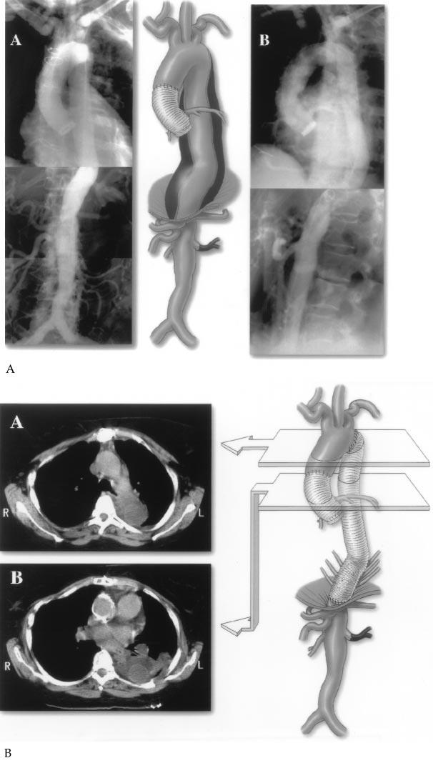 408 SAFI ET AL Ann Thorac Surg OPERATION FOR AORTIC DISSECTION: EARLY COMPLICATIONS 1998;66:402 11 Fig 4. Chronic type B dissection; completed graft replacement with intercostal artery reattachment.