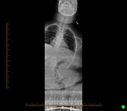 scoliosis is this?