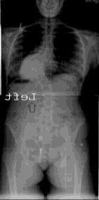 Advanced Imaging Thoracic Kyphosis Hypokyphosis typical of AIS Ganglioneuroma
