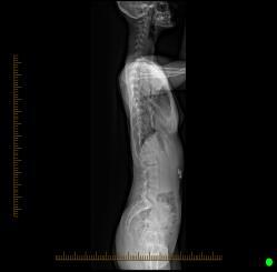 Loss of thoracic segment lordosis (more kyphosis) best single indicator (8/39)