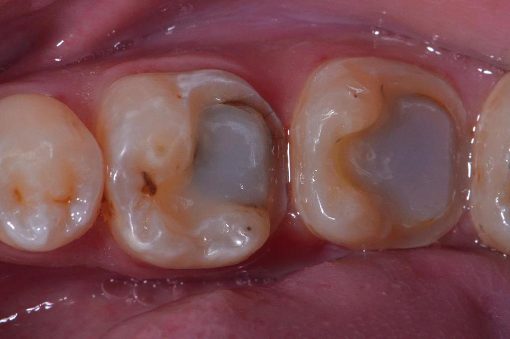 Figure 2: Immediate dentin
