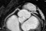 angiography > 50% diameter stenosis (%)