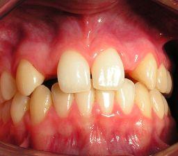 Maxillary lateral incisor Variations: the part where the