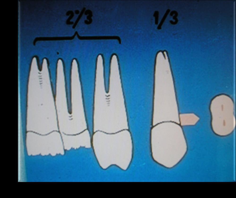 Maxillary first premolar Root: Of the