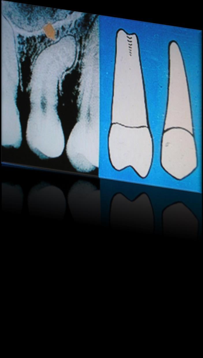 Root: 1 more massive and bigger than the 1st premolar crossection is irregularly flatend along the whole radix 1 or 2 canals