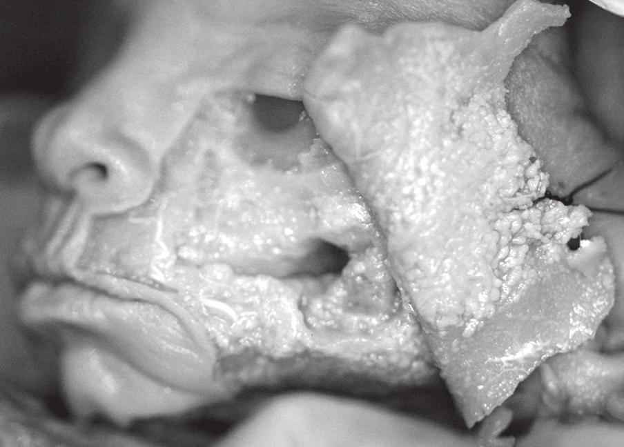 Folia Morphol., 2009, Vol. 68, No. 2 Figure 1. Foetus during preparation. Figure 2. Anastomosis running parallel to the alveolar process ridge.