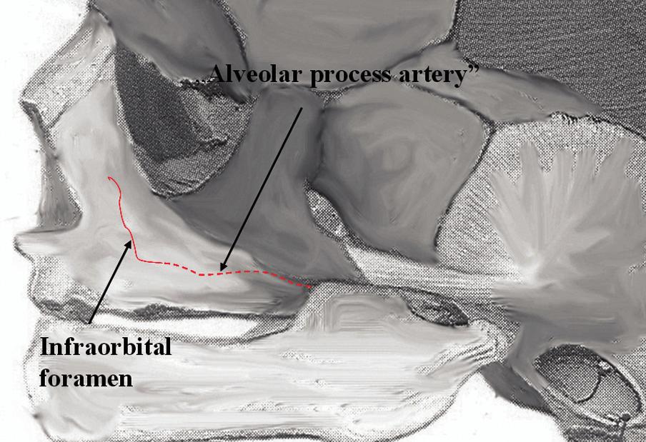 M. Rysz et al., The study of anastomoses of the alveolar process and the maxilla Figure 5. Anastomosis marked with a solid line; alveolar process artery marked with spotted line. A. Figure 7.