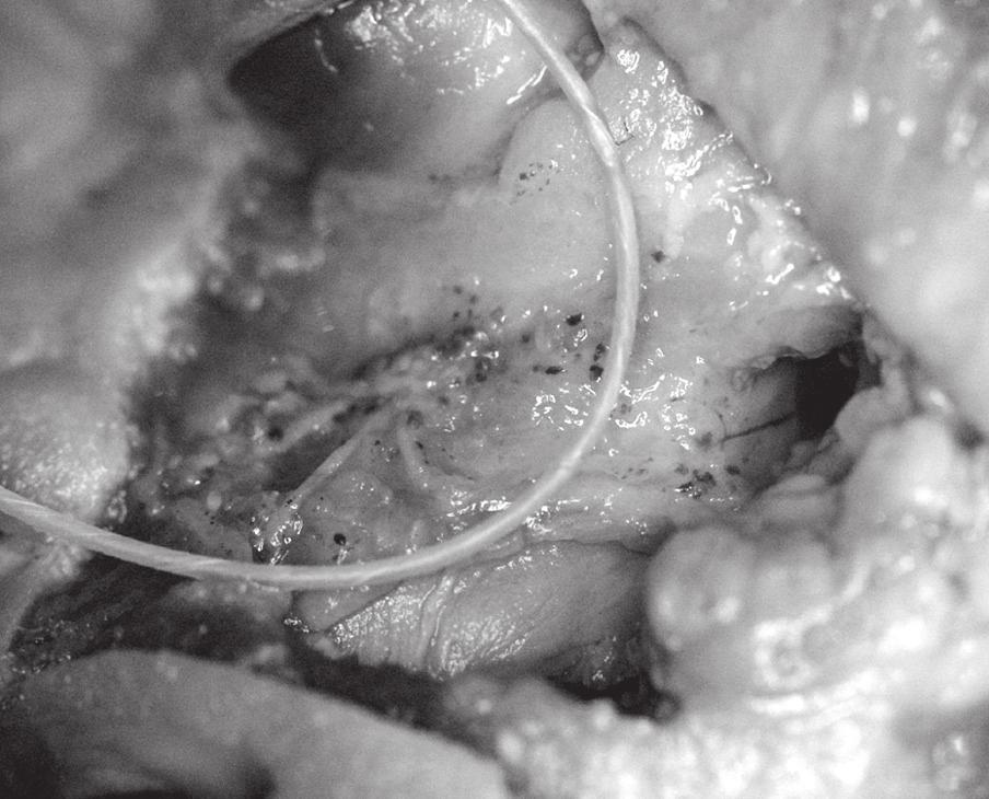 Folia Morphol., 2009, Vol. 68, No. 2 Figure 9. Anastomosis between infraorbital artery and posterior superior alveolar artery, visible over the filium, was not injected properly. Figure 10.