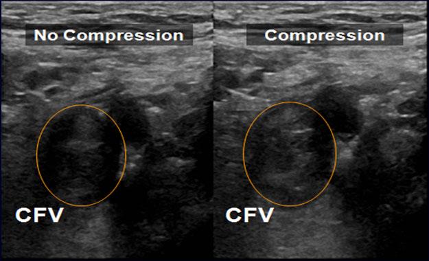 Ultrasound for DVT Diagnosis Risk Stratification for Acute DVT Acute DVT Iliofemoral DVT Non