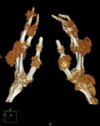 for measurement of bone changes Erosion Sclerosis Spur formation Conventional CT Popp Sem Arthritis Rheum 1996