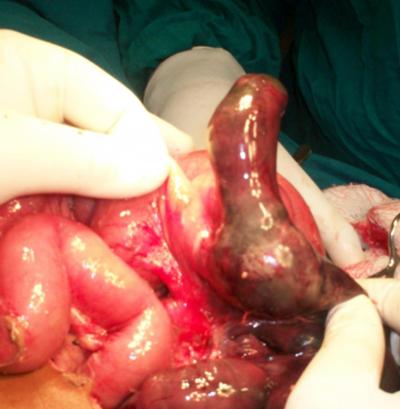 Figure 2 Figure 2: Gangrenous meckel's diverticulum Figure 3 Figure 3: Incidentally found Meckel's diverticulum DISCUSSION Failure of obliteration of the vitelline duct results in development of