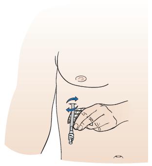 Check that the drainag e line and catheter valve are securely connected. Check if the catheter is clogged. If it is, roll it between your fingers.
