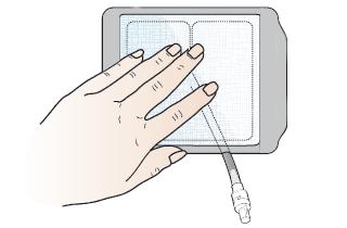 Press the bandage down, allowing the end of the catheter to come out from under the bandage (see Figure 16).