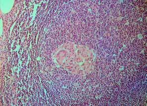 Wide erosion of bladder epithelium (bottom). Lamina propria shows neoangiogenesis (granulation tissue), edema and early collagenic fibrosis.