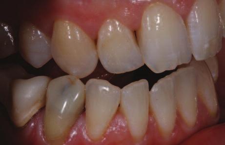 Clinical Figure 3: The substructure had an adverse effect on the shade of the composite build-up of tooth 43. Figure 4: Teeth 44 and 47 were re-prepared Figure 5:.