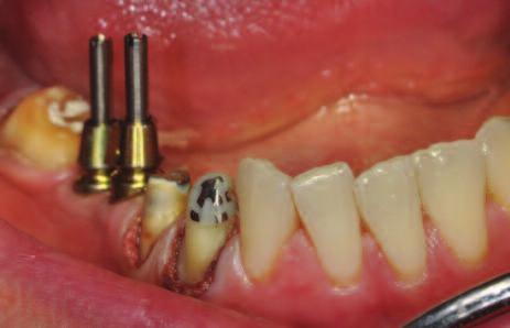 Shade A2 was established as the basic shade and a matching cervical shade was determined. Temporization was achieved with a temporary bridge made of Telio CAD.