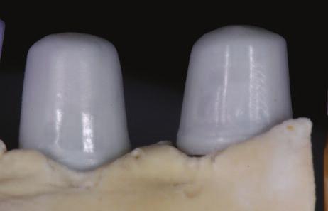 Figure 10: The implants were individually covered with shaded IPS e.max ZirCAD copings.