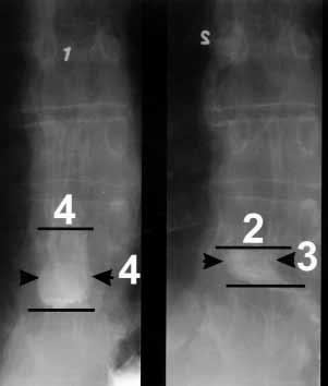 B, Postmyotomy TBEs at 1 and 2 minutes. Complete esophageal emptying was observed at 5 minutes. Fig 2. Premyotomy and postmyotomy barium column height at 1, 2, and 5 minutes.