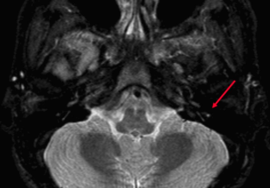 Fig. 11: Axial STIR Patient with facial neuritis. The facial nerve is nicely depicted here, in the descending portion of the petrosal bone. Fig.