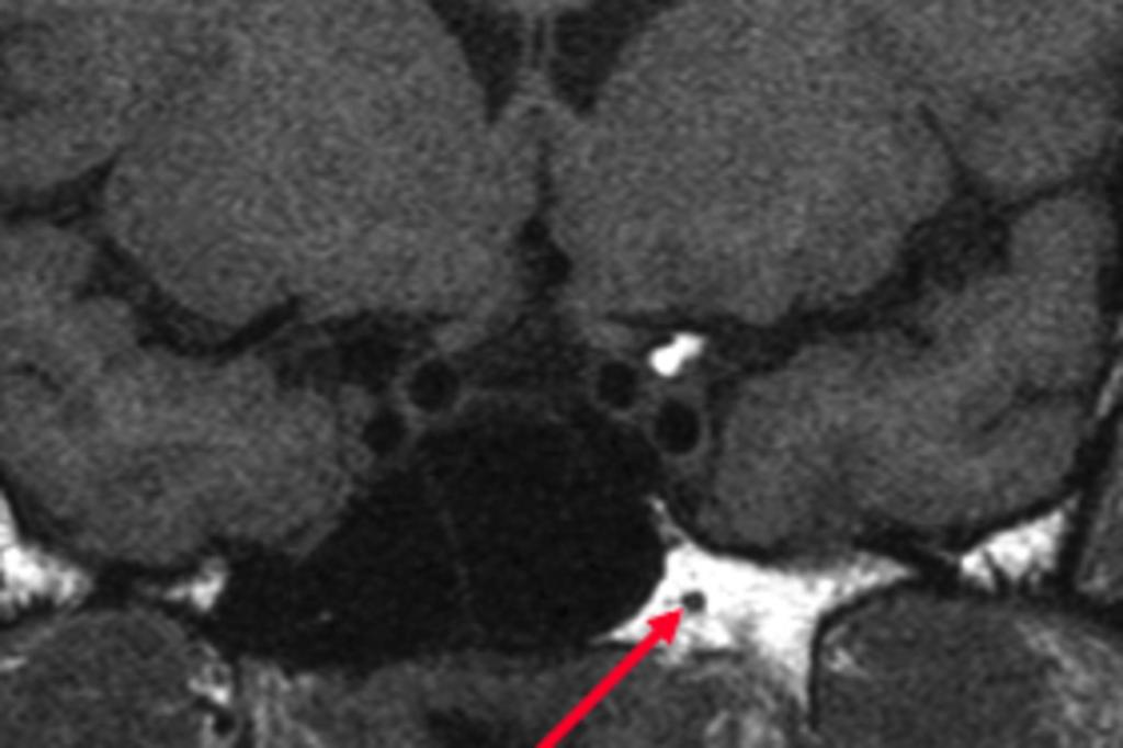 Fig. 12: Coronal T1 Vidian channel with the greater petrosal nerve, coming from the facial nerve and the deep petrosal nerve, coming from the sympathetic trunk.