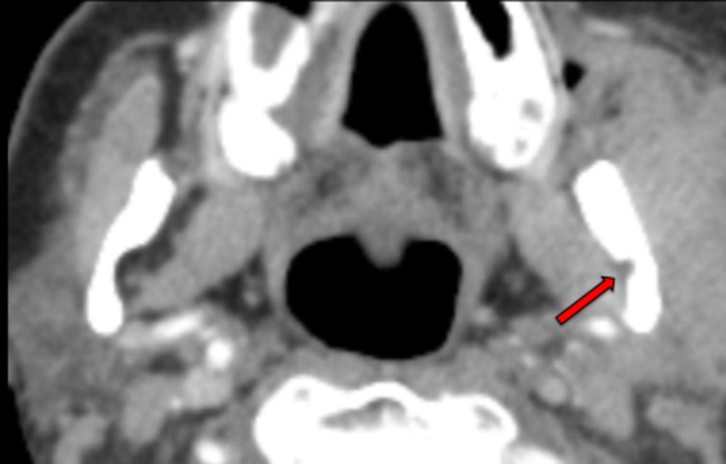 Fig. 15: Axial CT post contrast. Soft tissue window. The arrow points out obliterated fat, notice the normal right side.