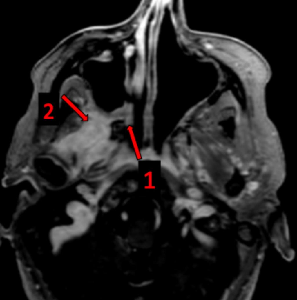 Fig. 16: Axial T1 post gadolinium. Question 5: How is the important anatomical site called at arrow 1?