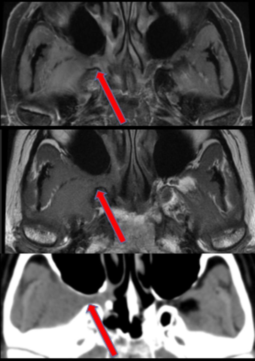 Fig. 18: From top to bottom: Axial MR T1; MR T1 post gadolinium; CT soft tissue window.