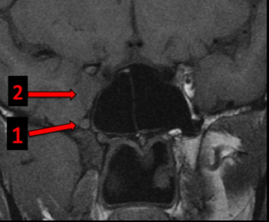 Fig. 20: MR coronal T1 Case of figure 17. From the inferior orbital fissure the tumor has spread further upward and intracranially.