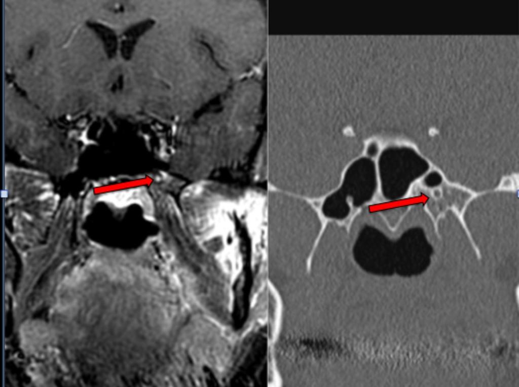 Fig. 21: MR coronal T1 post gadolinium (left) CT coronal bone window no contrast (right) The nerve in the foramen which is pointed out enhances vividly. On CT there is a normal appearance.