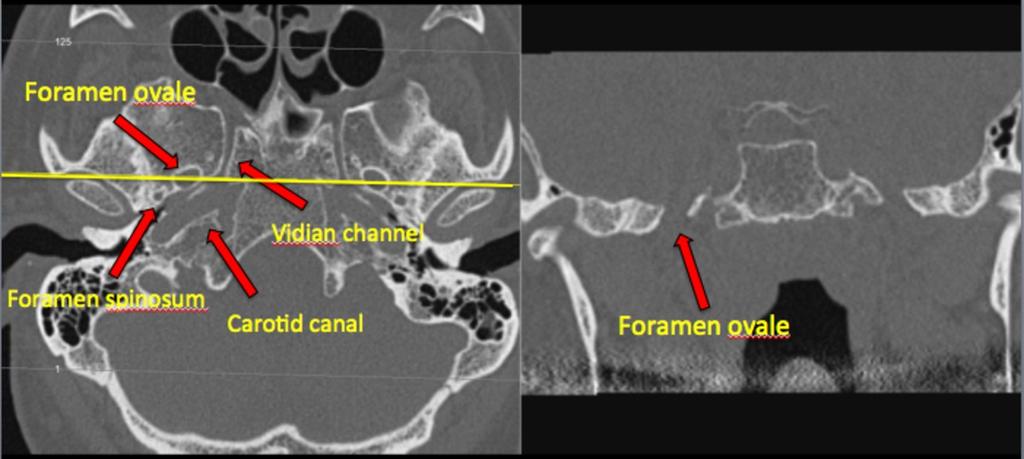 The first branch (ophtalmic/ V1) and the second branch (mandibular/v2) course through the cavernous sinus.