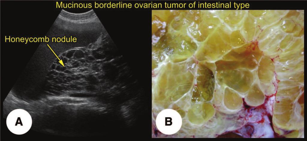 10 Diagnosing and Treating Borderline Ovarian Tumors Figure 3. Mucinous borderline tumor of intestinal type (transabdominal scan).