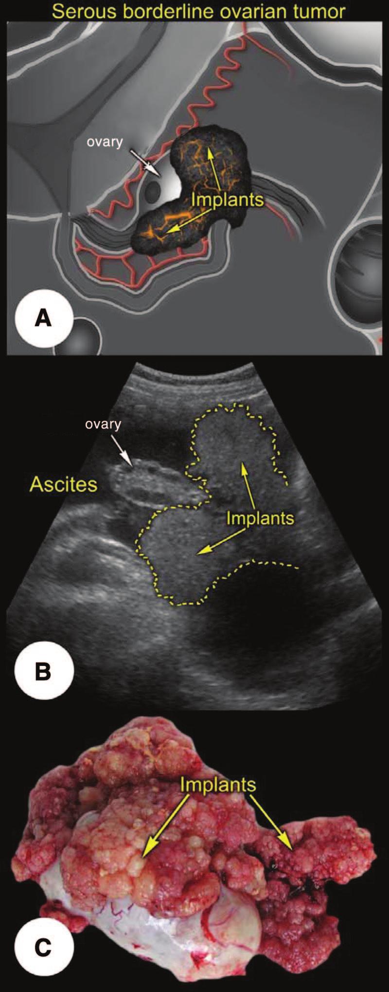 Fischerova, Zikan, Dundr et al. 11 Figure 4. Exophytic implants on the surface of contralateral ovary (transabdominal scan).