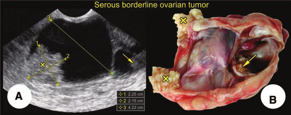 Fischerova, Zikan, Dundr et al. 9 Figure 1. Serous borderline tumor (transvaginal scan).