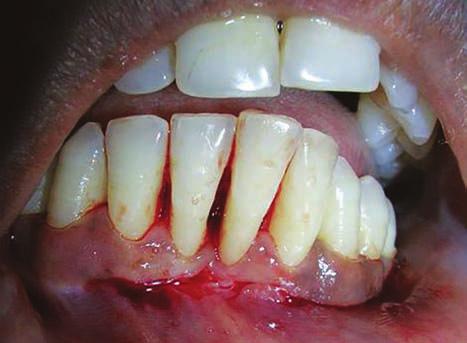 J linical pplication of Modified pically Repositioned Flap one or more teeth. The age of patients varied from 31 to 42 years (average age of 35.5 years).
